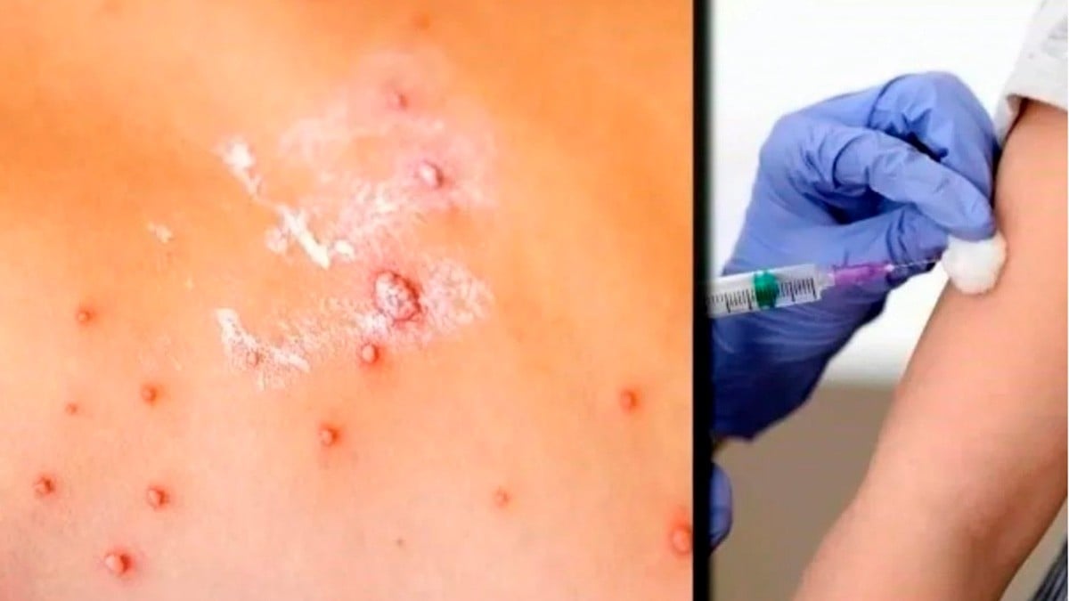 Alertan por expansión de sarampión ante baja vacunación