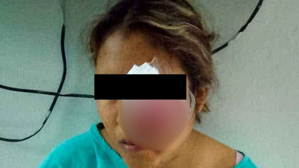 Mujer recogía su puesto de frituras cuando en riña le dieron pedrada y perdió el ojo