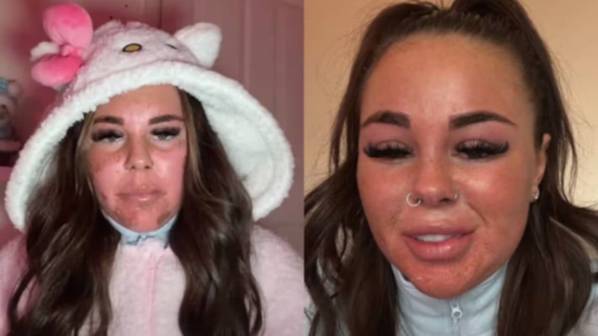 ¡Casi pierde el rostro! Mujer narra la terrible experiencia que vivió en una cama solar