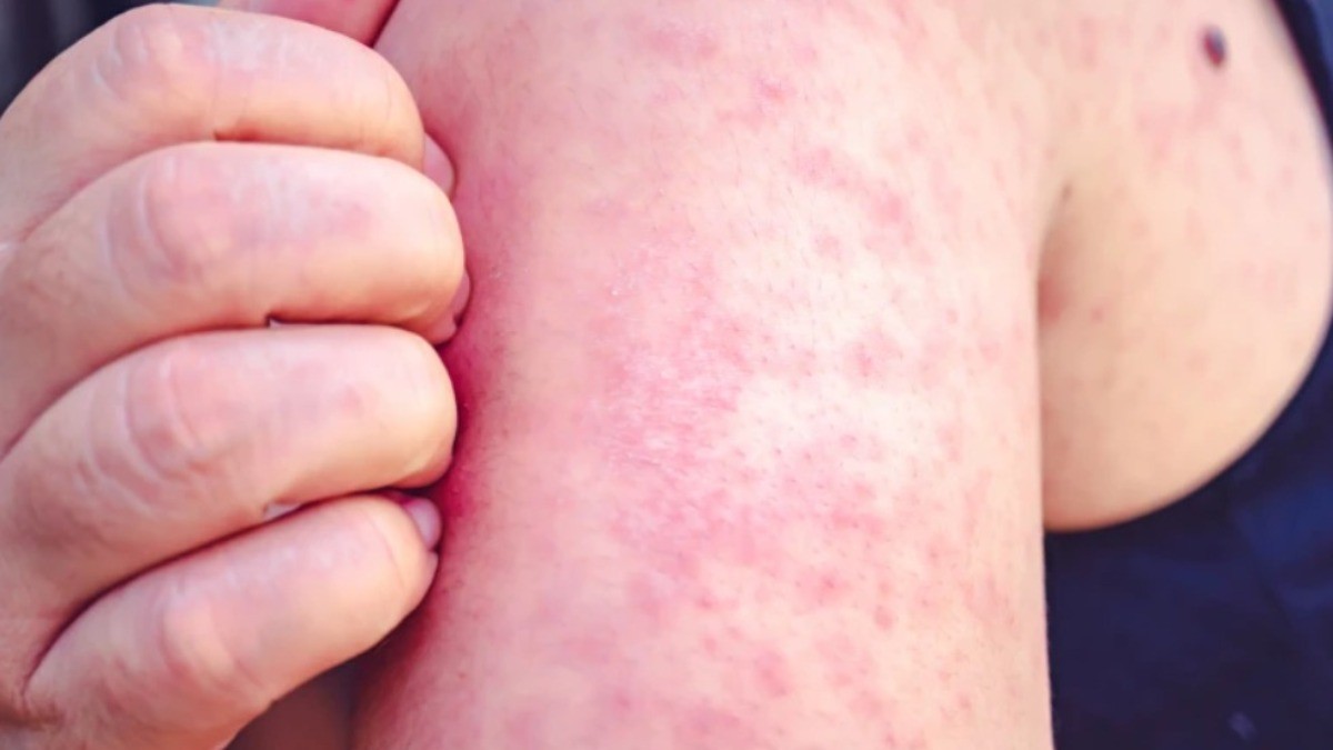 ¡No estaba vacunado! Confirman el primer fallecimiento por sarampión en este estado