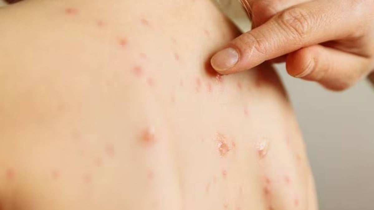 ¡Cuídate! Van 362 casos de sarampión y un muerto, estos son los estados más afectados