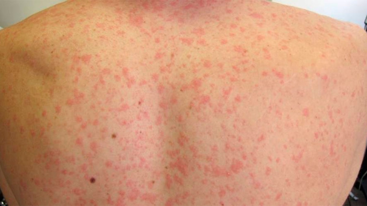 Especialista alerta sobre más contagios de sarampión en el estado y revela la causa