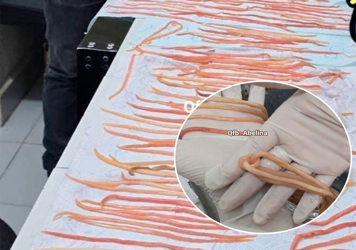 Niño acude al hospital por un dolor de estómago y le extirpan 142 lombrices del intestino