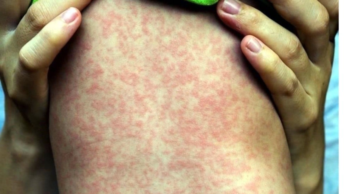 Suman 12 muertes por brote de sarampión