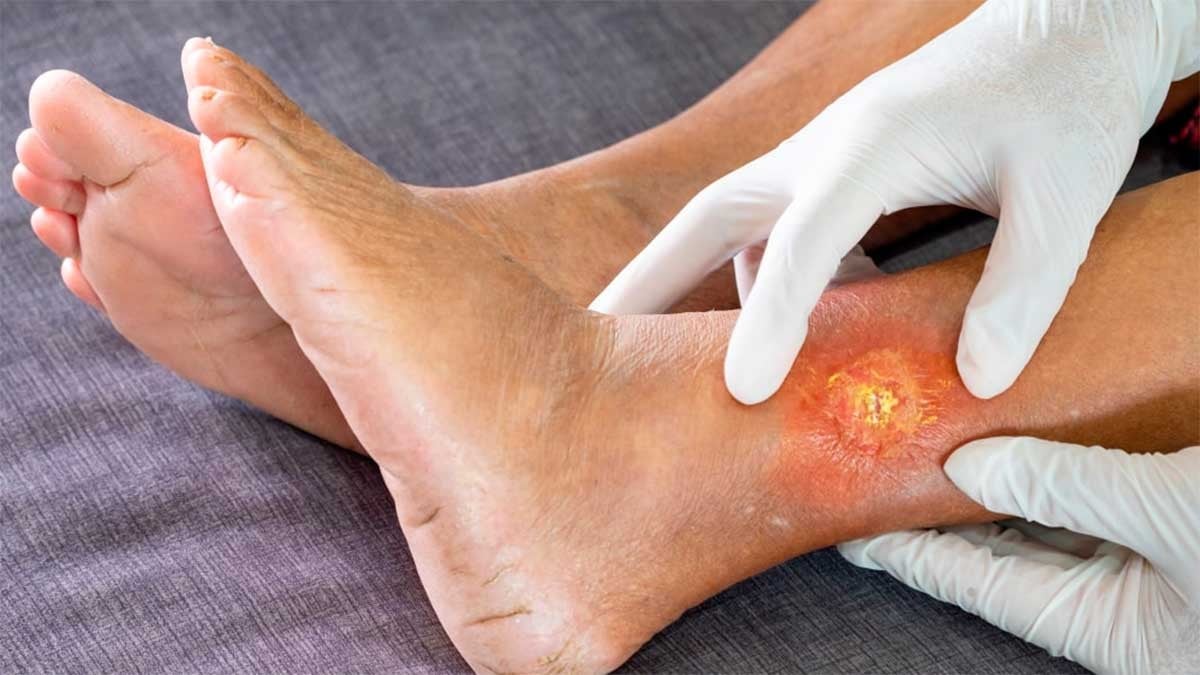 ¿Por qué el pie diabético es tan peligroso? Esto debes saber