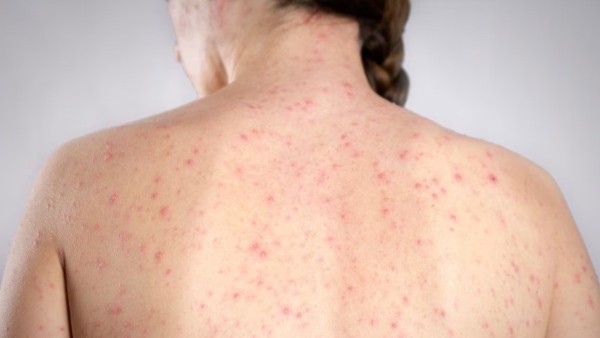 Alerta de sarampión: hay en el país 74 casos activos en estos estados