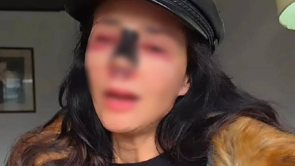 Se desfiguró el rostro: Querida actriz enfrenta secuelas tras cirugías estéticas fallidas