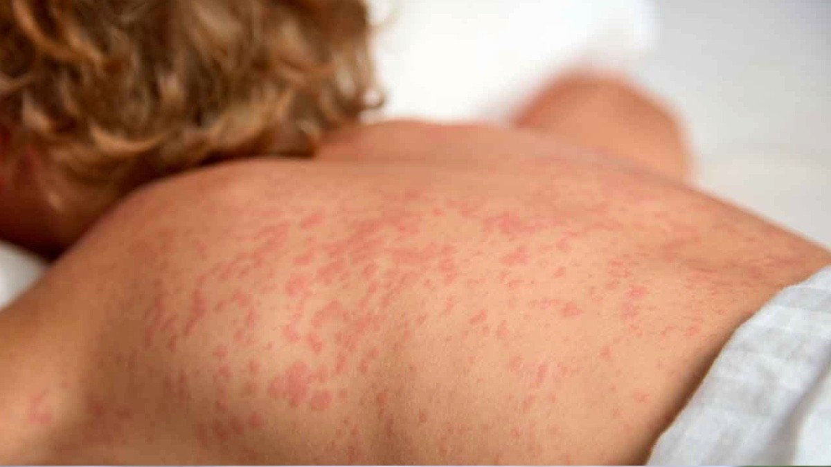 ¡Aumenta mortalidad! Suman cerca de 30 muertes por sarampión en México