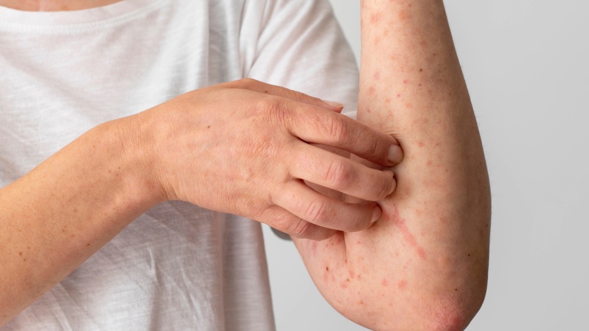 Urgen vacunarse en 7 estados con alto contagio de sarampión