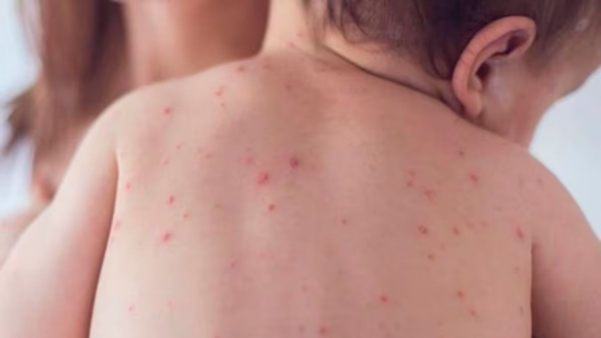 ¿Me puedo vacunar de sarampión de nuevo? Esto sabemos al respecto