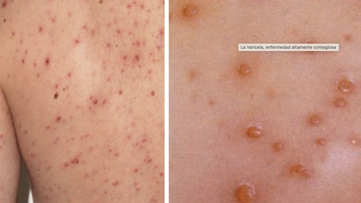 ¿Sarampión o varicela? Guía rápida para identificar sus diferencias y riesgos