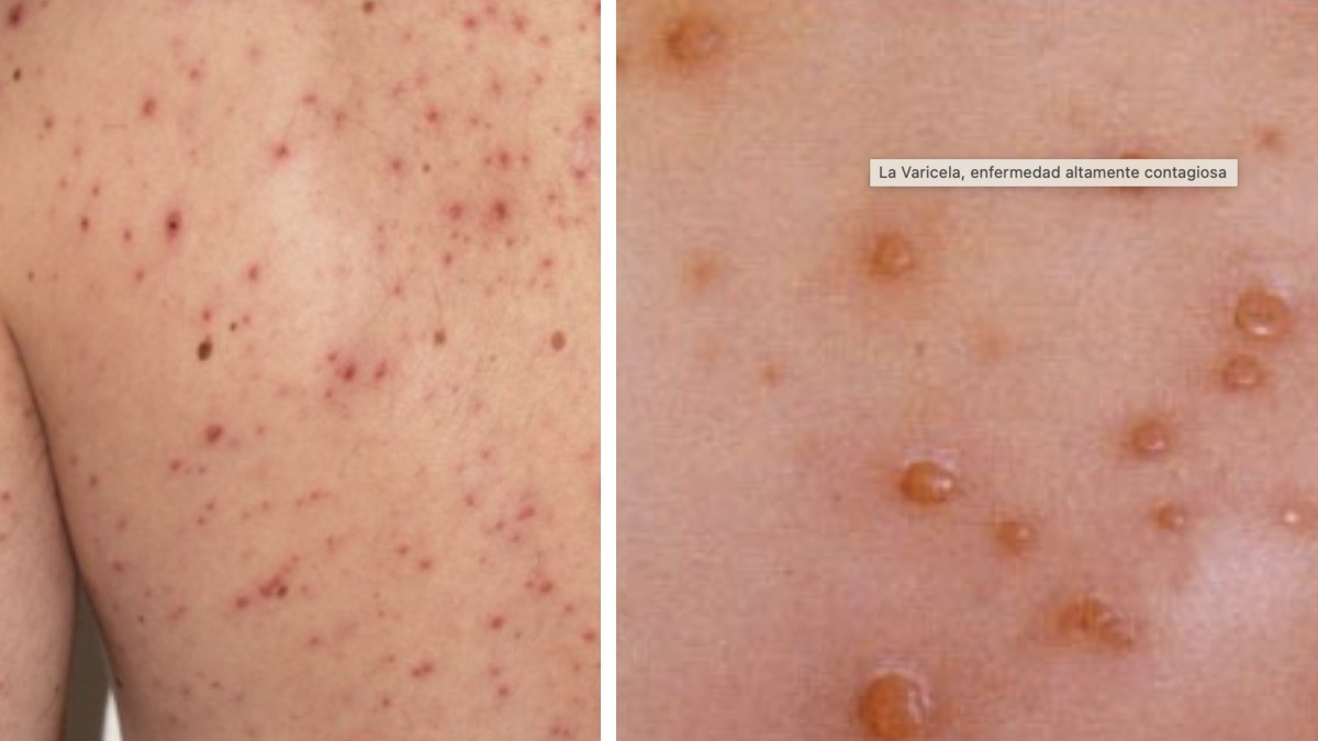 ¿Sarampión o varicela? Guía rápida para identificar sus diferencias y riesgos