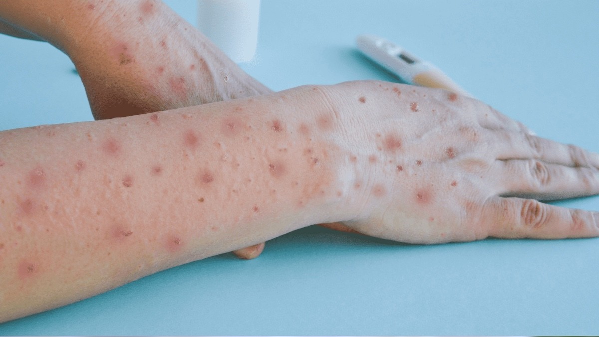 ¿No bastaba con el sarampión? Este mortal virus está repuntando en México