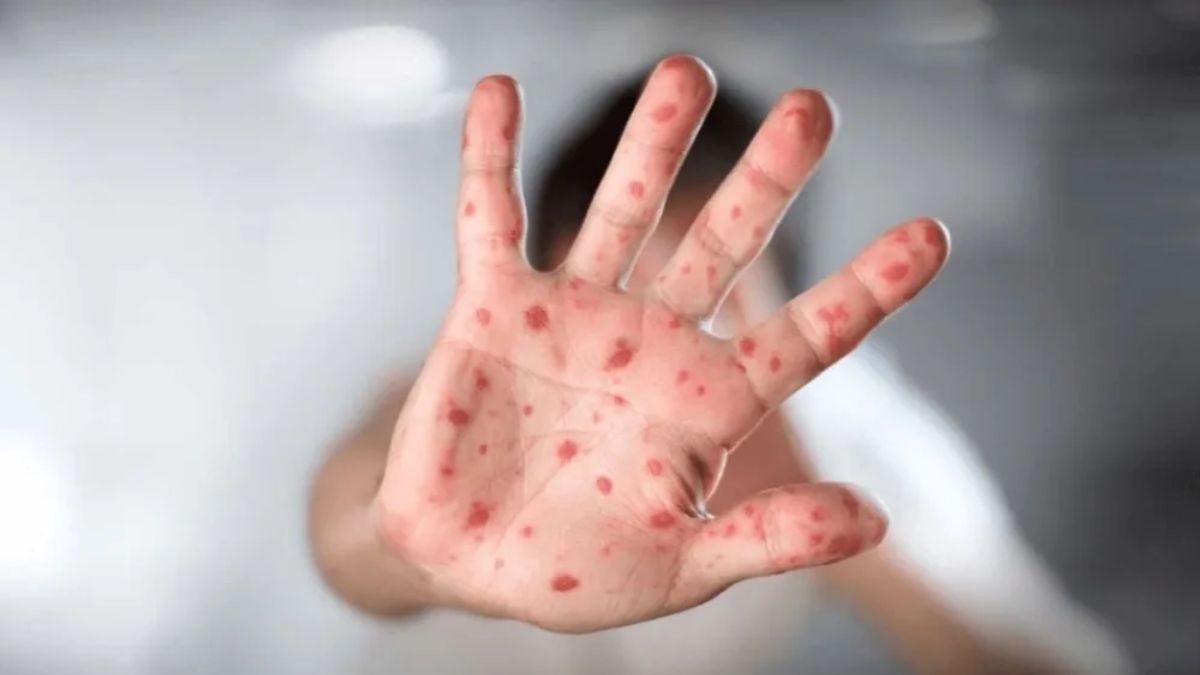 ¡Alerta en León! Confirman 5 casos de sarampión; intensifican cercos sanitarios 