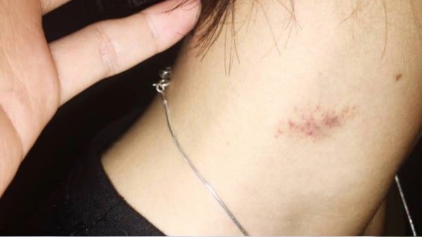 ¿Murió por qué? Adolescente falleció por 'chupetones' que le dio su novia