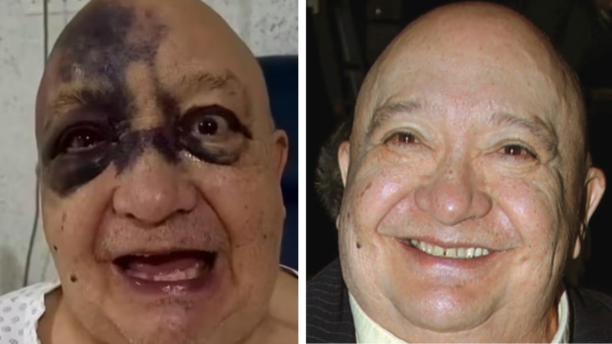¿Qué le pasó? ‘El Pirrurris’ sufre fuerte accidente y el rostro le queda con moretón negro