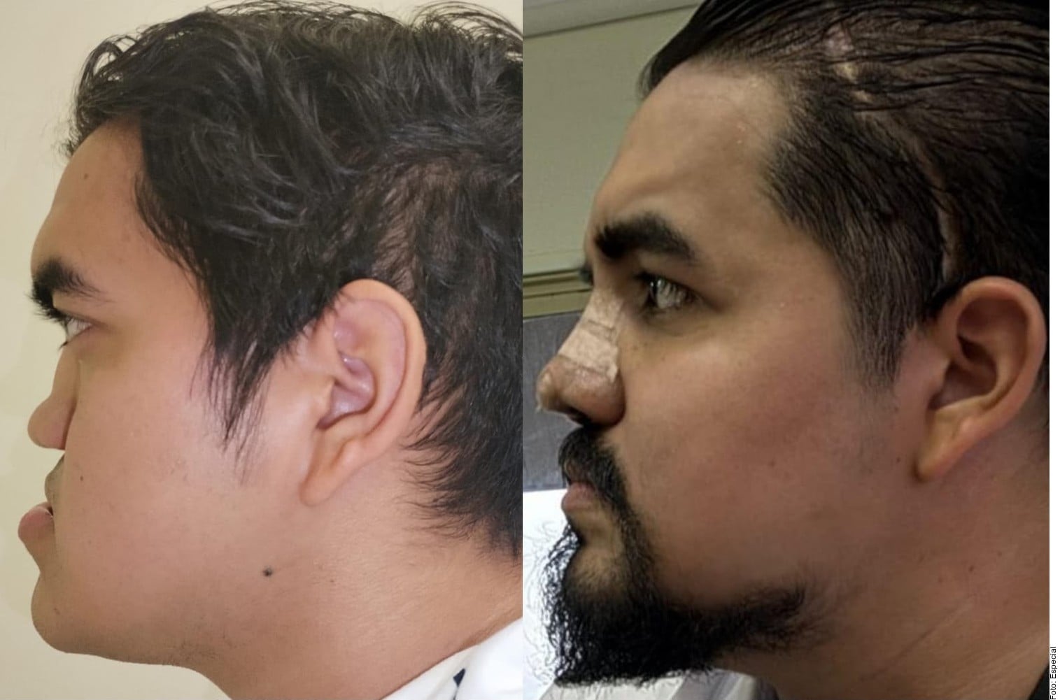 Reconstruyen rostro a paciente en IMSS NL