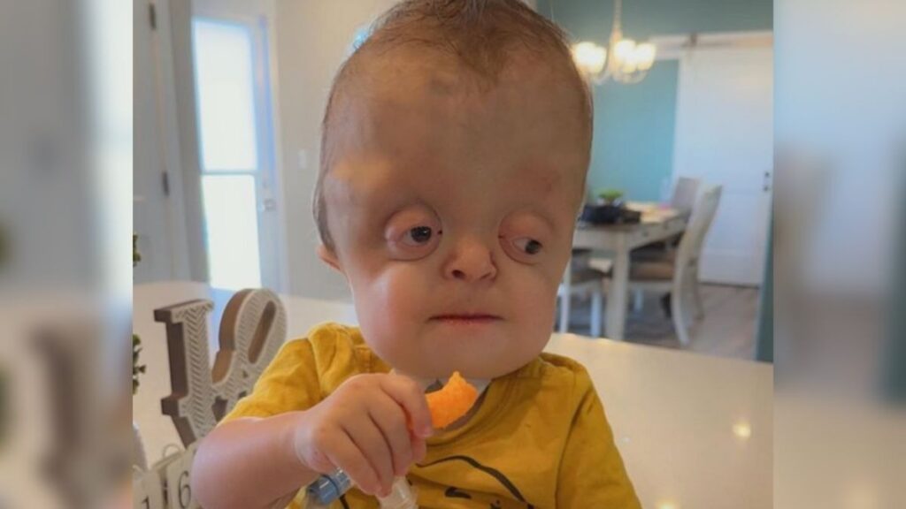 Bebé Raedyn nace con síndrome de Pfeiffer