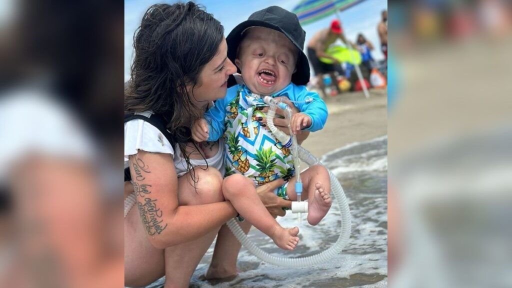 Bebé Raedyn nace con síndrome de Pfeiffer