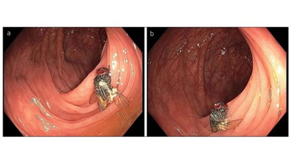 Mosca en el intestino