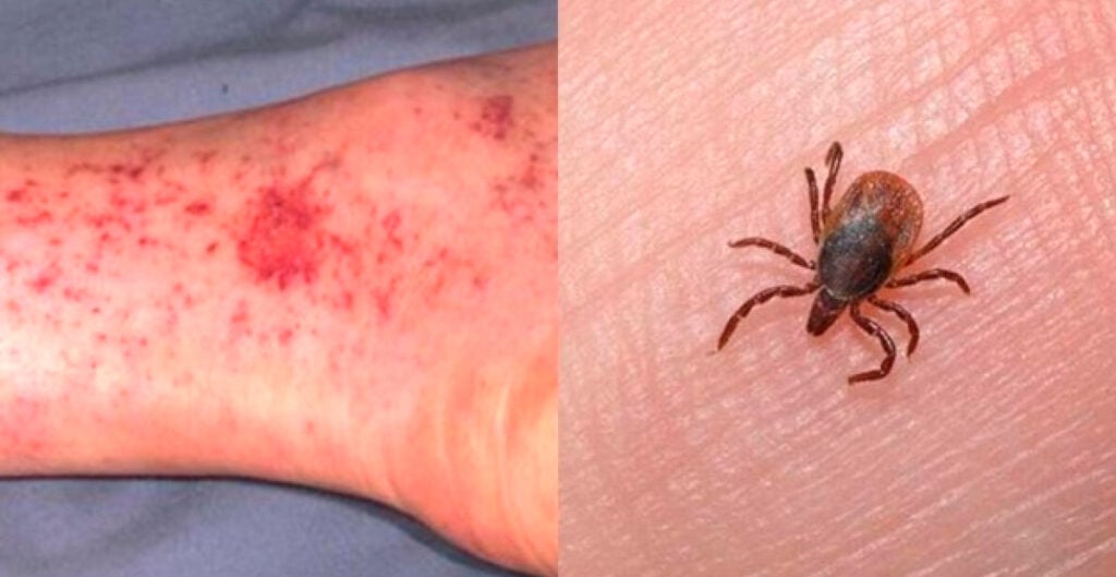 Mueren dos hermanitos debido a la picadura de una garrapata