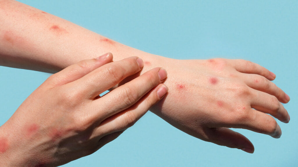 Sarampión
