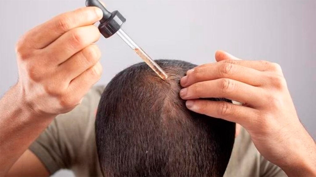 Minoxidil: qué es, para qué sirve y cómo saber si lo necesitas